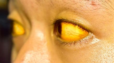 kulit dan mata kuning